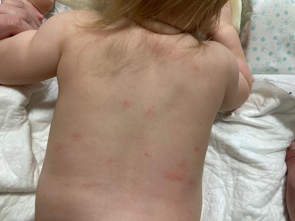 Vyrážka. Nevíte někdo prosím, co to je?