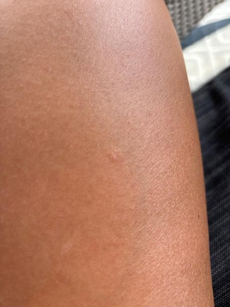 Co způsobuje svědivé vyrážky na těle? Zjistěte více!