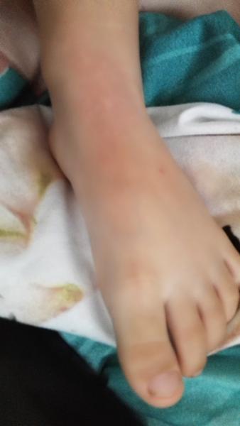 Pupínky na noze u 2leté dcerky. Poradíte, prosím?