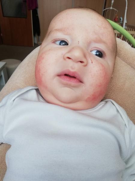 Vyrážka na obličeji a čelíčku, která se nelepší. Poradíte, prosím?