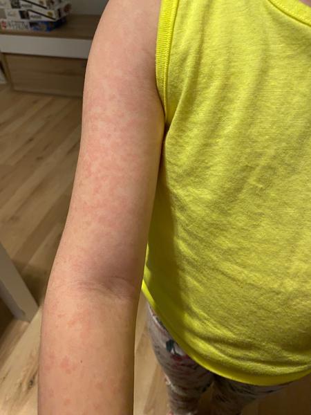 Co dělat, když Fenistil nepomáhá na dětskou vyrážku?