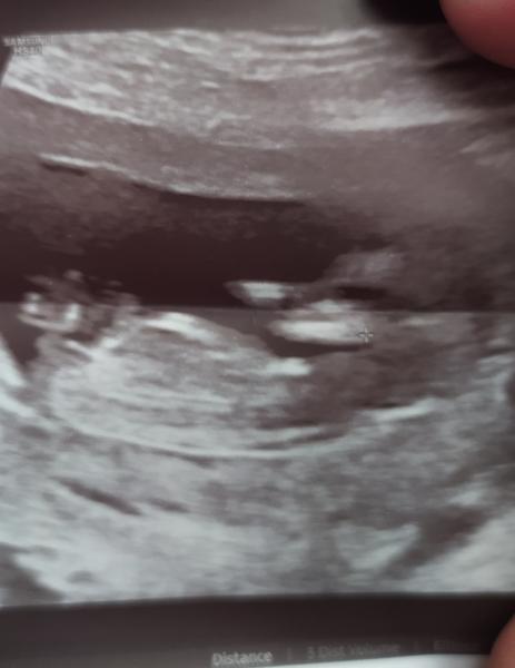 Chlapeček nebo holčička?