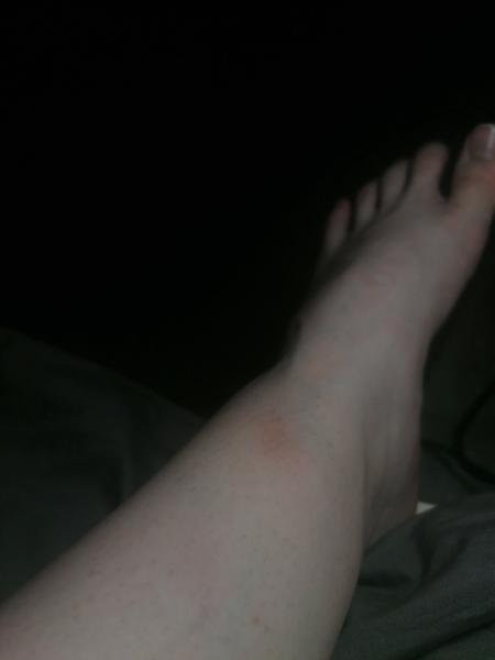 Červené modřiny na nohou. Jaké jsou vaše zkušenosti?