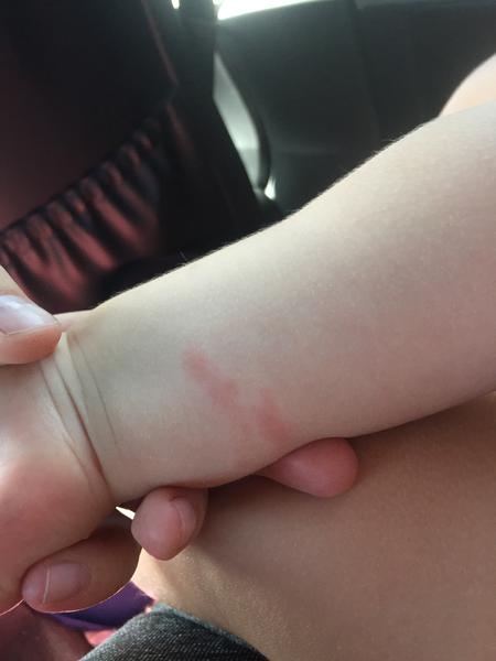 Osypaná/popálená/poštípaná ručička