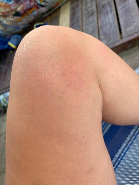 Je to alergie na něco? Poraďte se zkušenostmi!