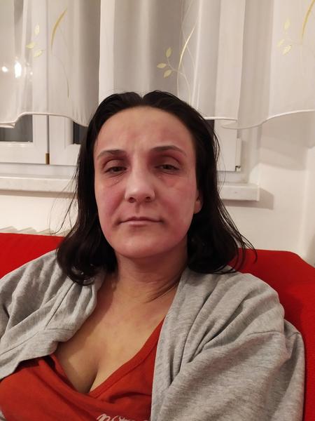 Atopický ekzém v těhotenství. Poradíte, prosím, co dělat?