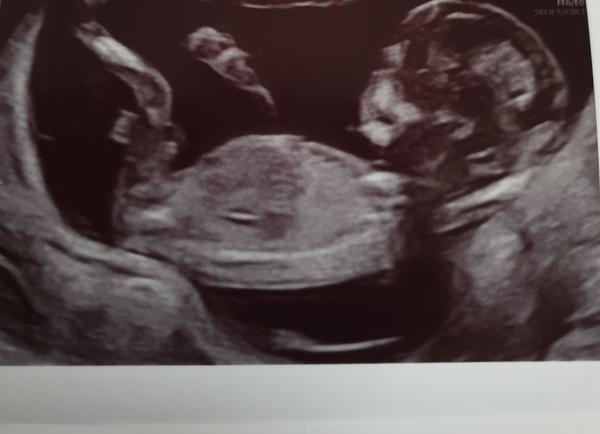 Pohlaví miminka. Poznal byste?