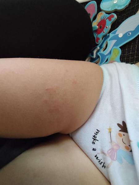 Vyrážka. Co by to mohlo být?