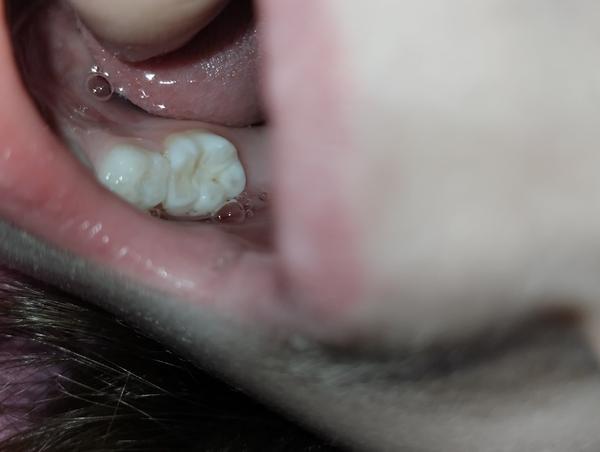 Je to kaz? Zkušenosti s ošetřením zubního kazu u dětí