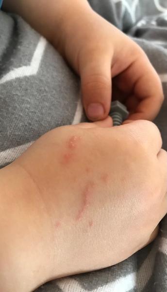 Jak poznat neštovice? Příznaky a diagnostika