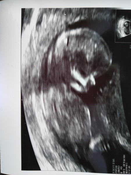 Pohlaví miminka. Dá se z toho určit?