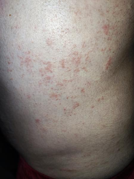 Pupínky a svědění celé rodiny. Je to svrab nebo ekzém?