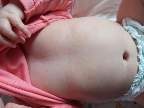 Krupička na bříšku u miminka. Jaké jsou příčiny a řešení?