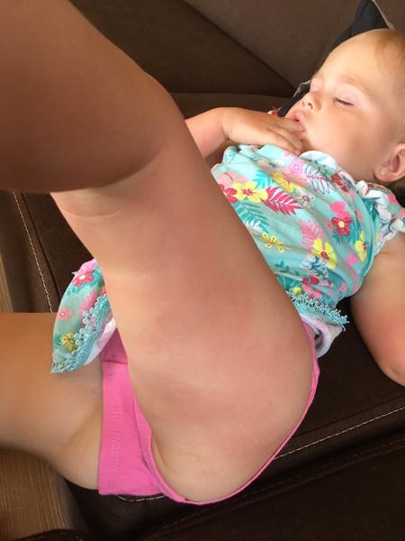 Fleky na noze. Mohla by to být borelióza? Nebo spíše alergie?