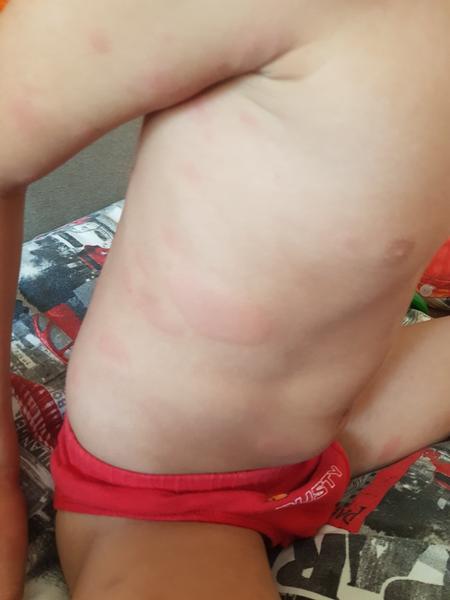 Nevíte, co je to za vyrážku u dítěte?