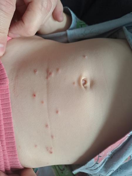 Puchýřky u dítěte. Může jít o alergickou reakci?