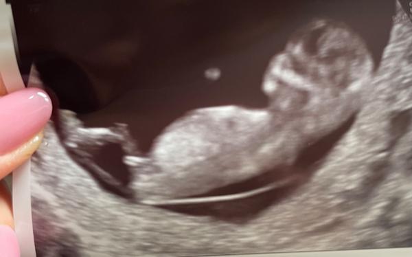 Jak poznat pohlaví z ultrazvuku ve 12. týdnu?