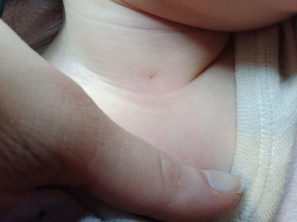 Dírka na krku. Co by to mohlo být a co s tím?