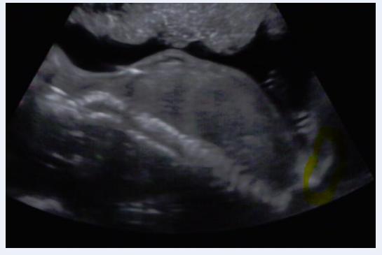 Foto z ultrazvuku 4D/2D 25.tt