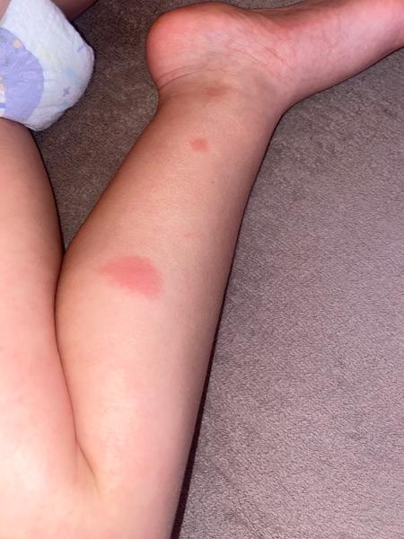 Je to vyrážka? Co značí skvrny na kůži dětí?