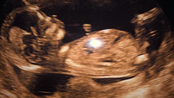 Pohlaví u miminka ve 13.tt. Co vidíte vy?