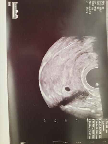 Zkušenosti s nízkým hCG v raném těhotenství: Je tu naděje?