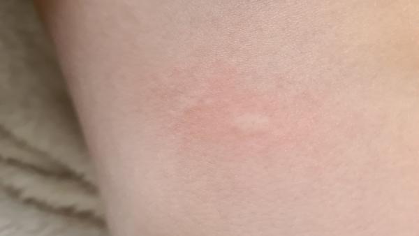 Červené fleky. Máte zkušenost? Kopřivka?