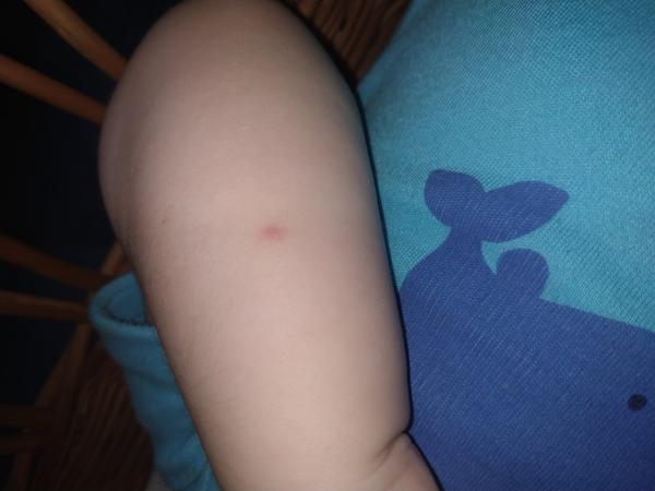 Myslíte, že se může jednat o neštovice?