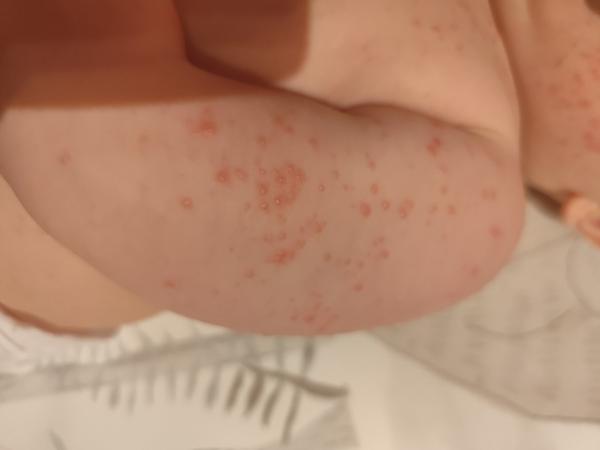 Pupínky u 9měsíčního dítěte. Co by to mohlo být a čím léčit?