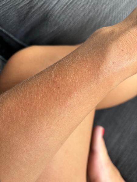 Co způsobuje svědivé vyrážky na těle? Zjistěte více!