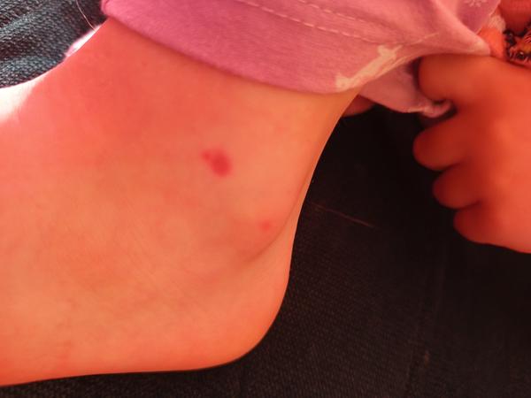 Neznámý flíček na kůži pětileté dcery. Co to může být?