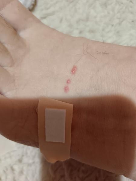 Zkušenosti se svědivými pupínky plnými tekutiny?