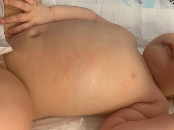 Vyrážka. Je lepší navštívit lékaře?