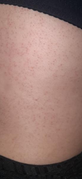 Vyrážka na zádech v 31. týdnu těhotenství?