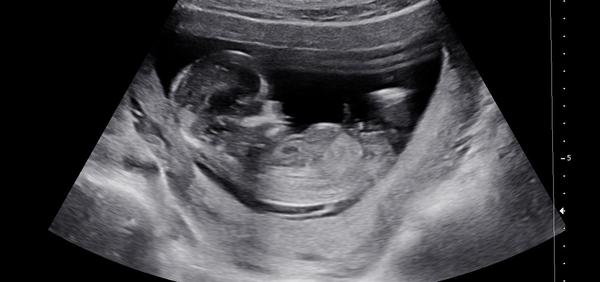 Dokáže lékař odhadnout pohlaví v 13. týdnu?