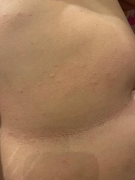 Vyrážka. Co by to mohlo být?