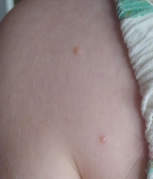 Jak se zbavit neznámého útvaru na rameni dcery?