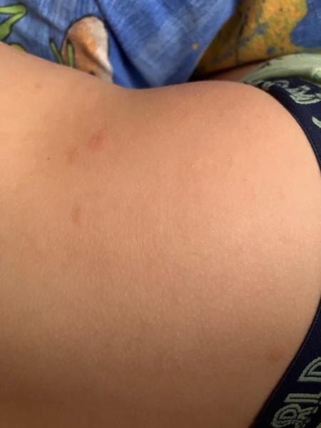 Červené flíčky. Mohou být z Nurofenu?