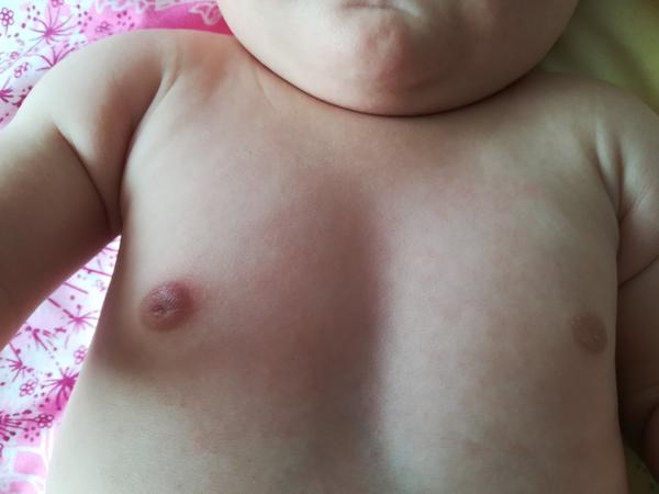 Bulka na bradavce u syna 5 měsíců. Co by to mohlo být?