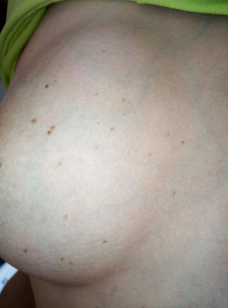 Znaménka na prsu. Hormonální změna nebo zajít na kožní?