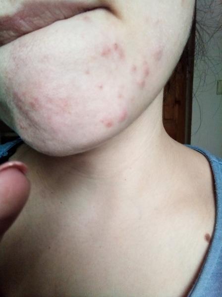 Kožní problémy na bradě. Poradíte?