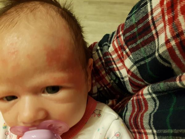 Vyrážka u měsíčního miminka