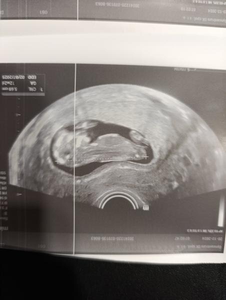 Pohlaví - 1. screening. Dá se určit?