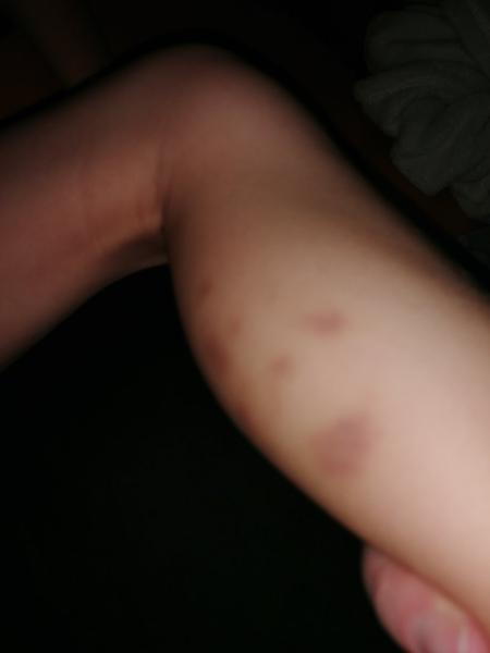 Je normální, když se objevují modřiny na nohách u dětí?