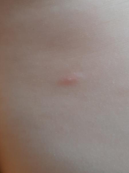 Varilrix očkování: Je možné se nakazit neštovicemi?