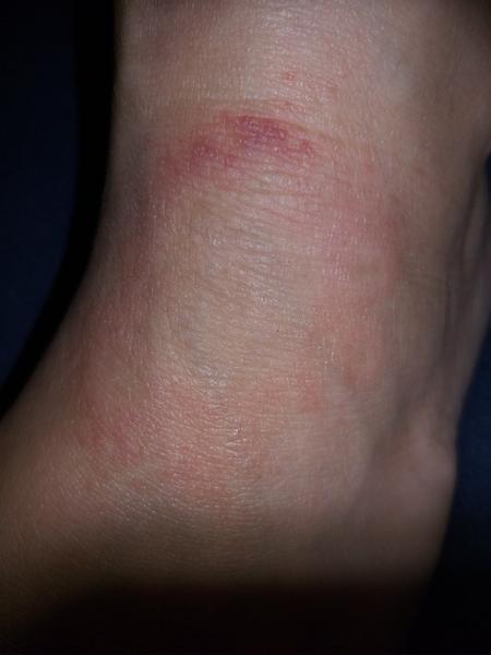 Červený flek na nártu. Borelióza, mykóza nebo něco jiného?