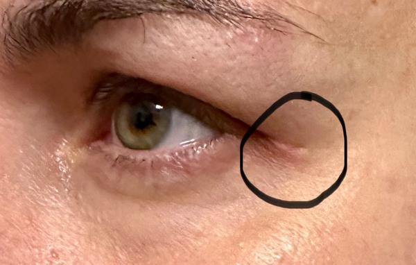 Jizva po operaci očních víček. Co s tím?