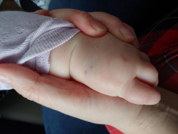 Modřina. Poradíte, prosím?