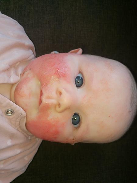 Rozsáhlý ekzém. Pomůžete, prosím?