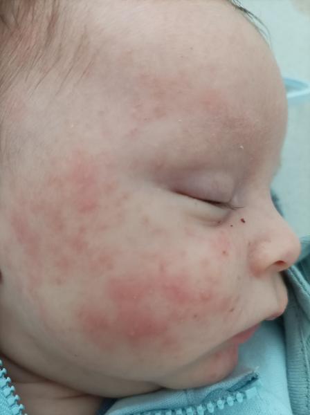 Kožní vyrážka a bílá mapa na čele při styku s vodou. Poradíte, prosím?